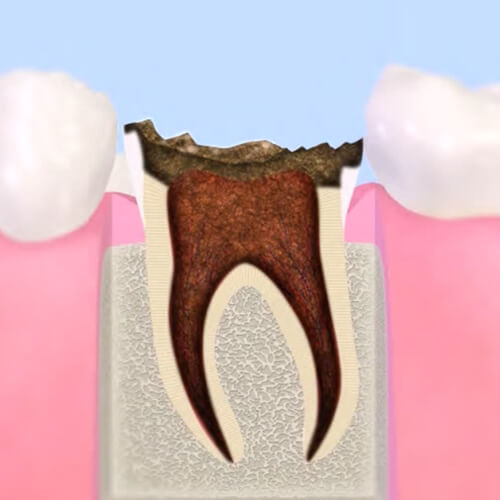 歯質が失われた歯（C4）
