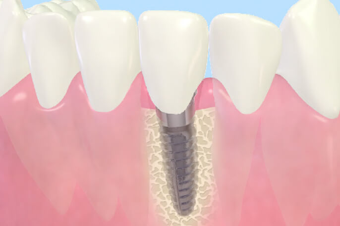 インプラント