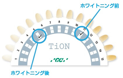 歯ぎしり