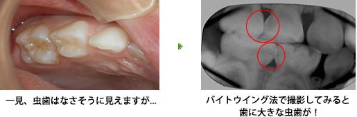 バイトウィング法(咬翼法)