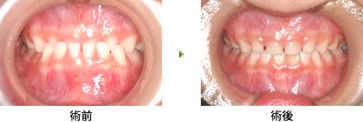 乳歯列反対咬合（前歯の咬み合わせが反対）
